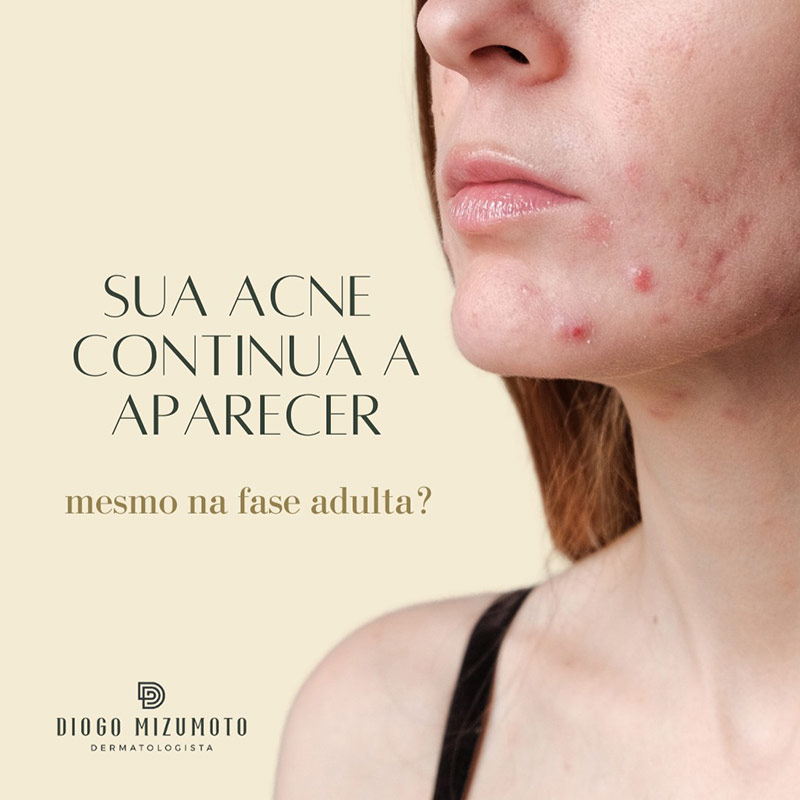Tratamento para acne e cicatrizes