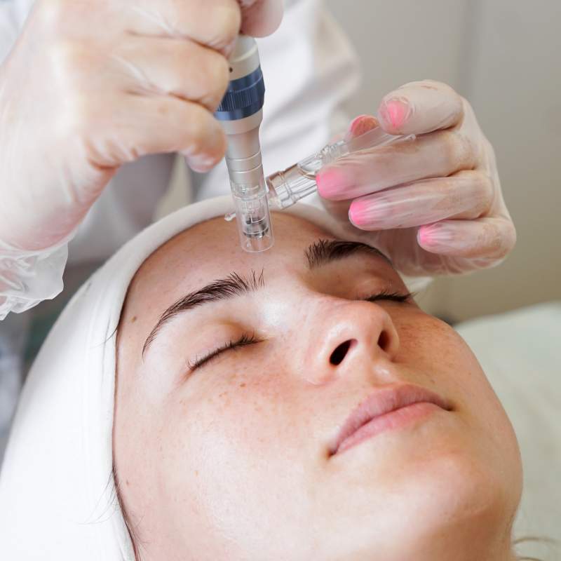 Bioestimuladores de colageno Sculptra ou Radiesse