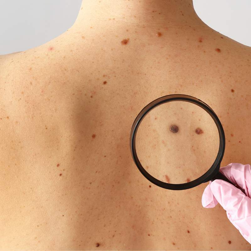 Dermatologista avaliação de pintas na pele