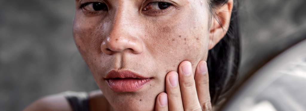 O verão pode piorar o melasma?